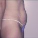 Tummy Tuck Patient 01 Before 1 - Thumbnail