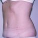 Tummy Tuck Patient 01 Before 2 - Thumbnail