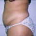 Tummy Tuck Patient 02 Before 1 - Thumbnail