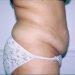 Tummy Tuck Patient 02 Before 2 - Thumbnail