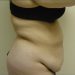 Tummy Tuck Patient 03 Before 1 - Thumbnail