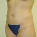Tummy Tuck Patient 05 Before 1 - Thumbnail