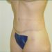 Tummy Tuck Patient 05 After 1 - Thumbnail