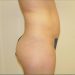 Tummy Tuck Patient 05 Before 2 - Thumbnail