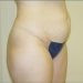 Tummy Tuck Patient 07 Before 1 - Thumbnail