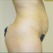 Tummy Tuck Patient 07 Before 2 - Thumbnail