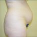 Tummy Tuck Patient 08 Before 1 - Thumbnail