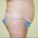 Tummy Tuck Patient 11 Before 2 - Thumbnail