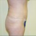 Tummy Tuck Patient 11 After 2 - Thumbnail