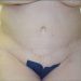 Tummy Tuck Patient 12 After 1 - Thumbnail