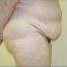 Tummy Tuck Patient 12 Before 2 - Thumbnail