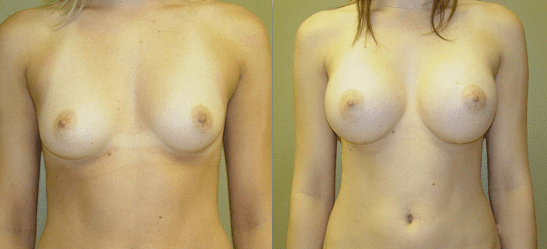 The Difference Between Saline and Silicone Implants - Feature Image