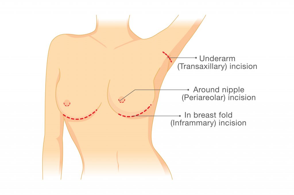 Image result for breast augmentation incision sites