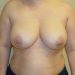 Breast Implant Removal Patient 09 Before 1 - Thumbnail