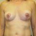 Breast Implant Removal Patient 07 After 1 - Thumbnail