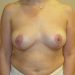 Breast Implant Removal Patient 04 After 1 - Thumbnail