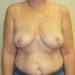 Breast Implant Removal Patient 12 After 1 - Thumbnail