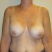 Breast Implant Removal Patient 12 Before 1 - Thumbnail