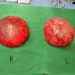 Breast Implant Removal Patient 01 Before 1 - Thumbnail