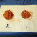 Breast Implant Removal Patient 17 Before 4 - Thumbnail