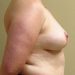 Breast Implant Removal Patient 27 After 3 - Thumbnail