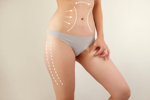 Get Rid of Fat With Liposuction - Feature Image