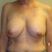 Breast Implant Removal Patient 31 Before 1 - Thumbnail