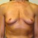 Breast Implant Removal Patient 35 After 1 - Thumbnail