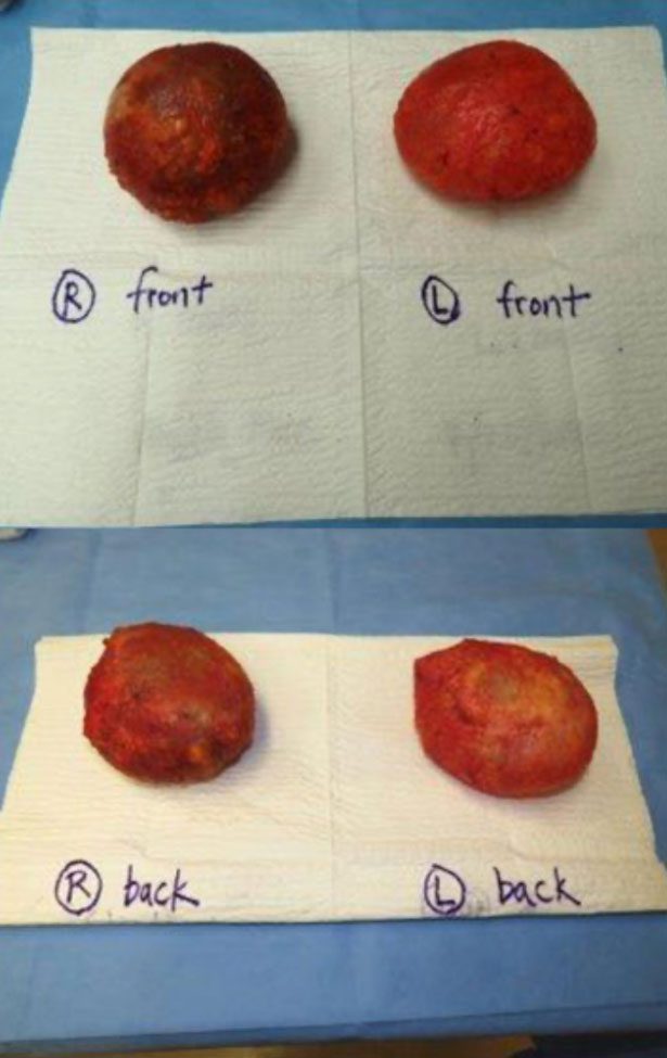 samples of breast implant removals back & front