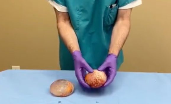 Doctor holding implants