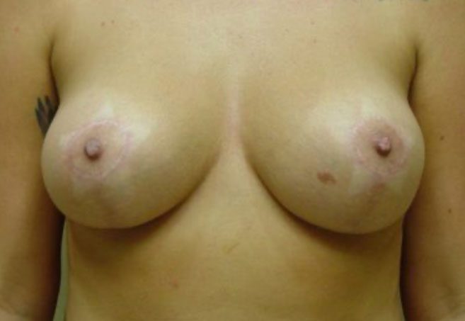 patient after breast implant removal