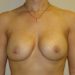 Breast Implant Removal Patient 45 Before 1 - Thumbnail